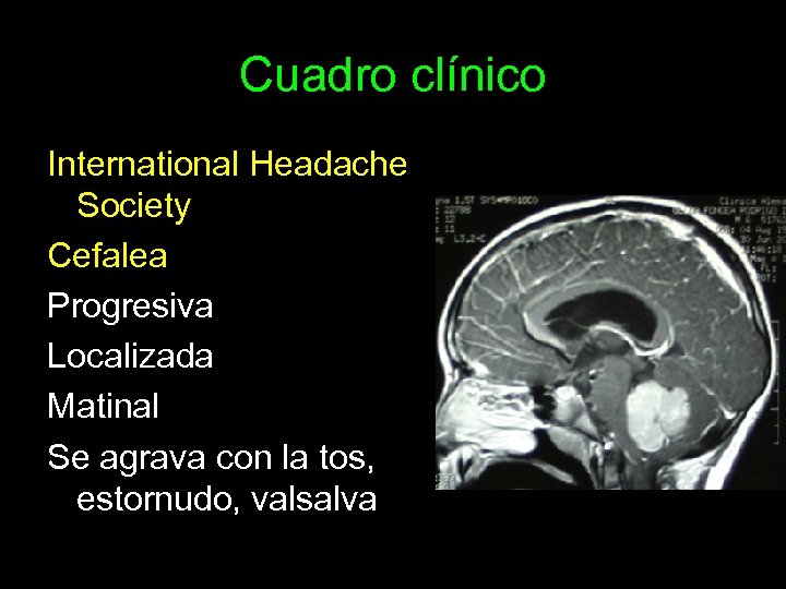 Cuadro clínico International Headache Society Cefalea Progresiva Localizada Matinal Se agrava con la tos,