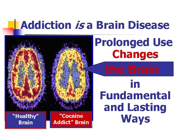 Addiction is a Brain Disease Prolonged Use Changes the Brain “Healthy” Brain “Cocaine Addict”