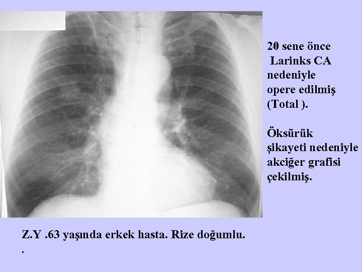 20 sene önce Larinks CA nedeniyle opere edilmiş (Total ). Öksürük şikayeti nedeniyle akciğer