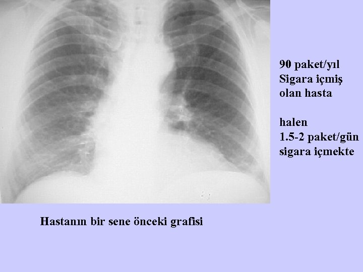 90 paket/yıl Sigara içmiş olan hasta halen 1. 5 -2 paket/gün sigara içmekte Hastanın