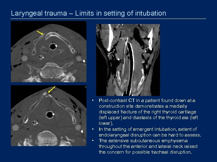 Laryngeal trauma – Limits in setting of intubation • • • Post-contrast CT in