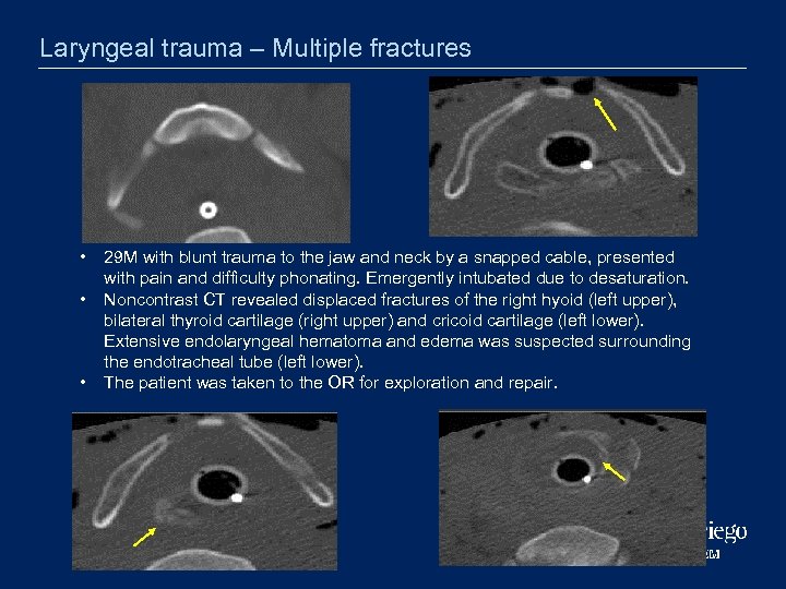 Laryngeal trauma – Multiple fractures • • • 29 M with blunt trauma to