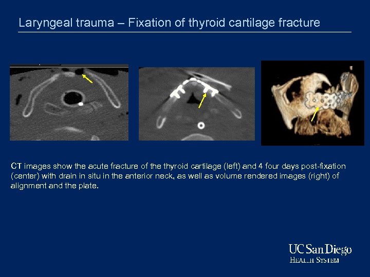 Laryngeal trauma – Fixation of thyroid cartilage fracture CT images show the acute fracture