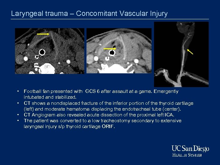 Laryngeal trauma – Concomitant Vascular Injury • • Football fan presented with GCS 6