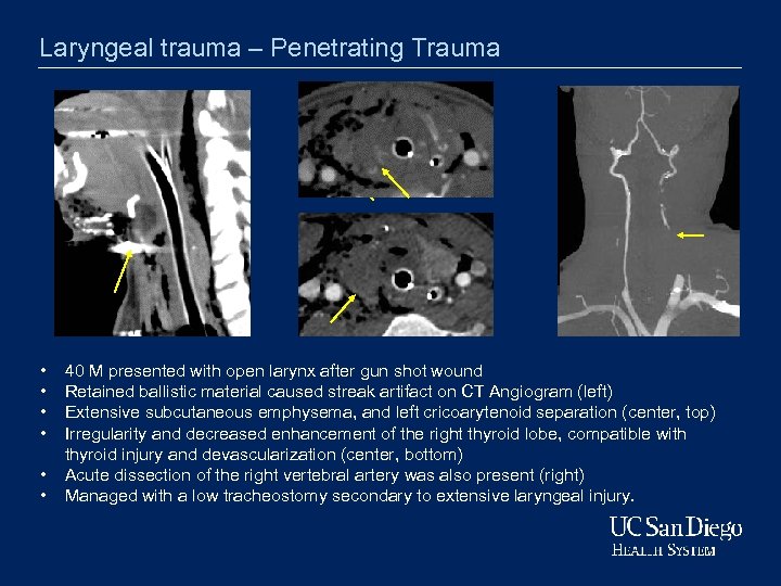 Laryngeal trauma – Penetrating Trauma • • • 40 M presented with open larynx