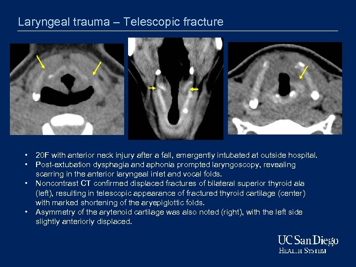 Laryngeal trauma – Telescopic fracture • • 20 F with anterior neck injury after