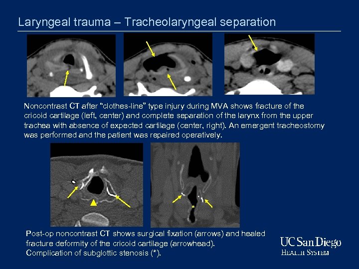 Laryngeal trauma – Tracheolaryngeal separation Noncontrast CT after “clothes-line” type injury during MVA shows