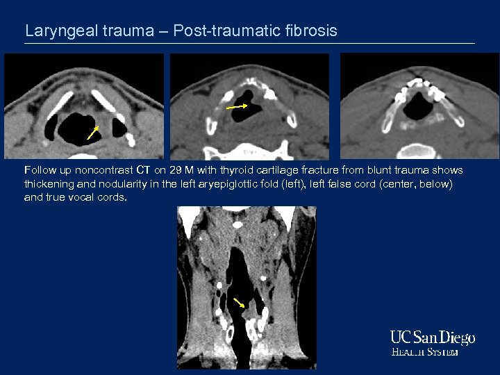 Laryngeal trauma – Post-traumatic fibrosis Follow up noncontrast CT on 29 M with thyroid