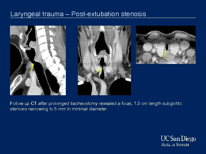 Laryngeal trauma – Post-extubation stenosis Follow up CT after prolonged tracheostomy revealed a focal,