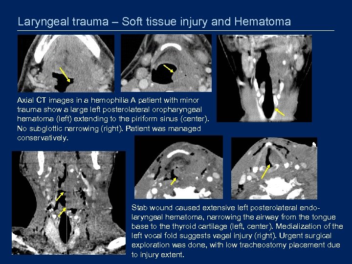 Laryngeal trauma – Soft tissue injury and Hematoma Axial CT images in a hemophilia