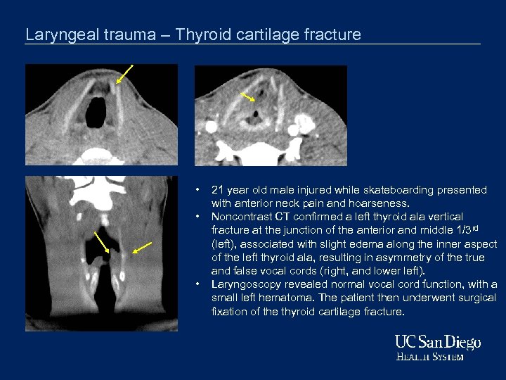 Laryngeal trauma – Thyroid cartilage fracture • • • 21 year old male injured