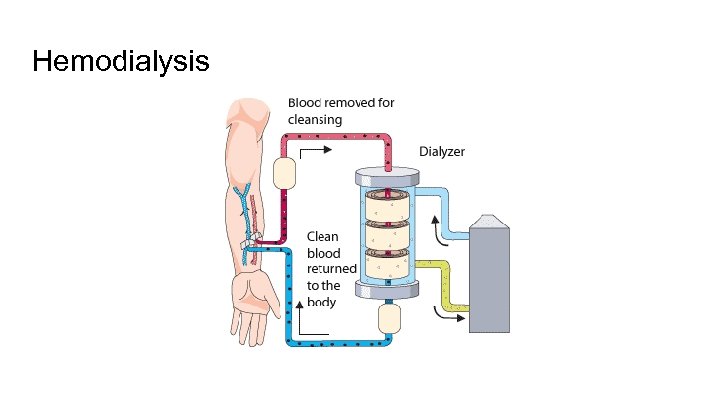 Hemodialysis 