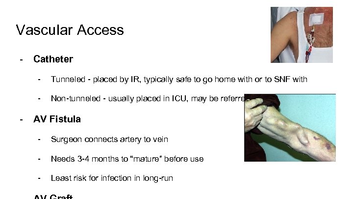 Vascular Access - Catheter - - Tunneled - placed by IR, typically safe to