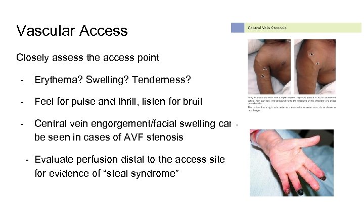 Vascular Access Closely assess the access point - Erythema? Swelling? Tenderness? - Feel for