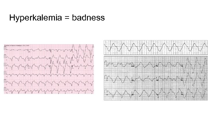 Hyperkalemia = badness 