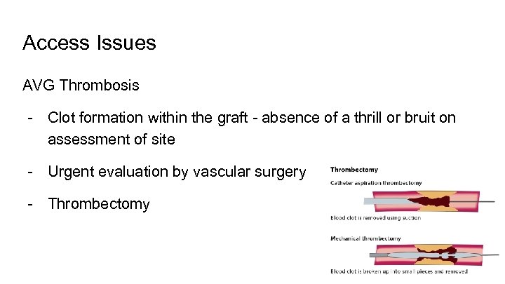 Access Issues AVG Thrombosis - Clot formation within the graft - absence of a