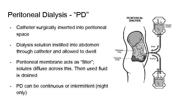 Peritoneal Dialysis - “PD” - Catheter surgically inserted into peritoneal space - Dialysis solution