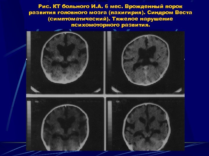 Рис. КТ больного И. А. 6 мес. Врожденный порок развития головного мозга (пахигирия). Синдром