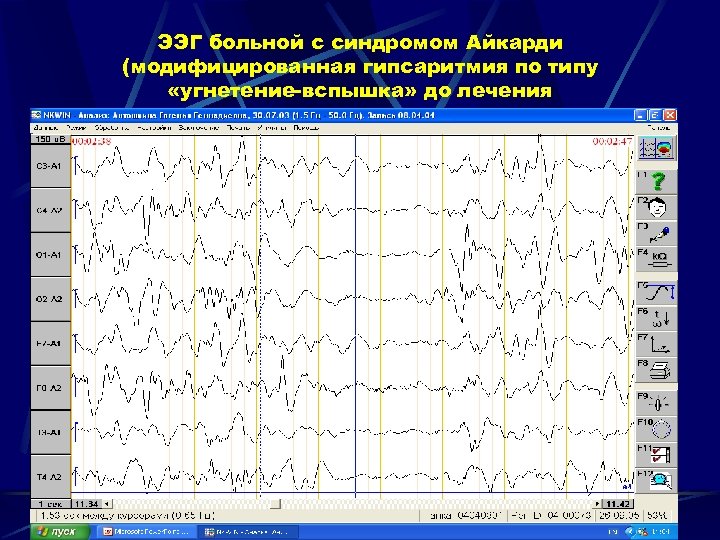 ЭЭГ больной с синдромом Айкарди (модифицированная гипсаритмия по типу «угнетение-вспышка» до лечения 