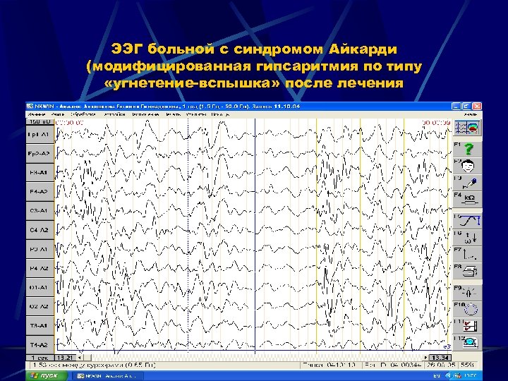 ЭЭГ больной с синдромом Айкарди (модифицированная гипсаритмия по типу «угнетение-вспышка» после лечения 