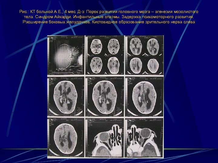 Рис. : КТ больной А. Е. , 4 мес. Д-з: Порок развития головного мозга