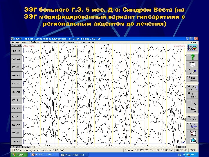 ЭЭГ больного Г. Э. 5 мес. Д-з: Синдром Веста (на ЭЭГ модифицированный вариант гипсаритмии