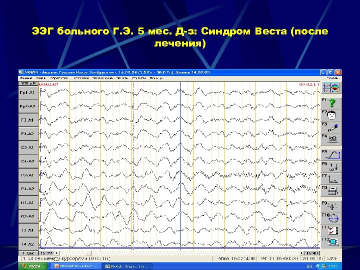 ЭЭГ больного Г. Э. 5 мес. Д-з: Синдром Веста (после лечения) 