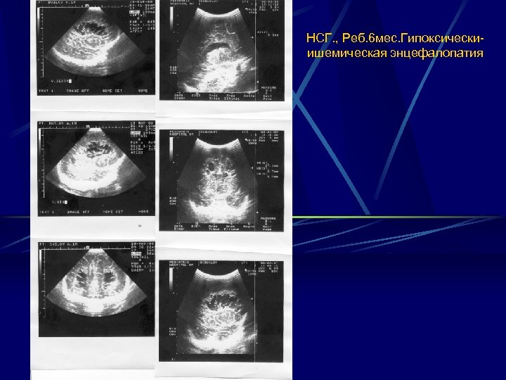  НСГ. , Реб. 6 мес. Гипоксическиишемическая энцефалопатия 