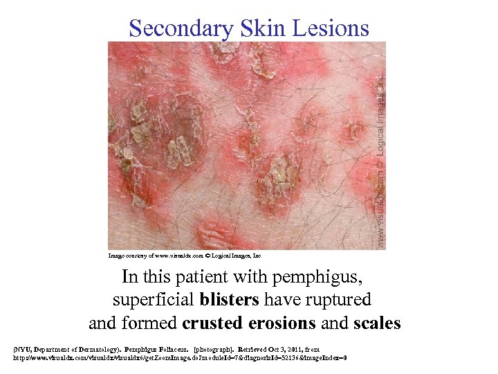 Secondary Skin Lesions Image courtesy of www. visualdx. com © Logical Images, Inc In