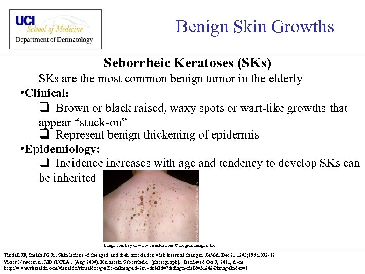 Benign Skin Growths Seborrheic Keratoses (SKs) SKs are the most common benign tumor in