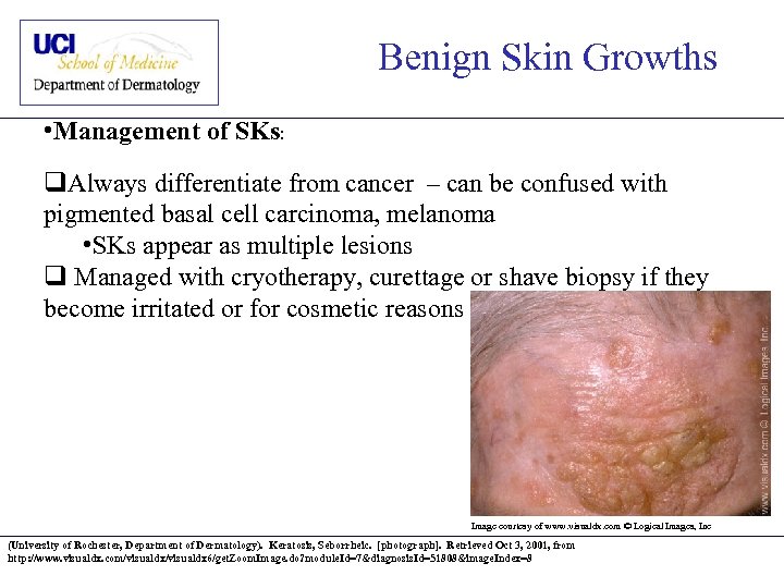 Benign Skin Growths • Management of SKs: q. Always differentiate from cancer – can