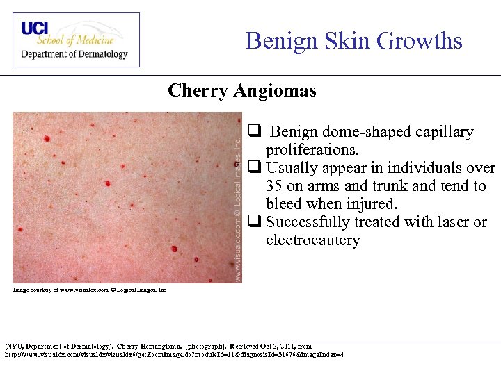 Benign Skin Growths Cherry Angiomas q Benign dome-shaped capillary proliferations. q Usually appear in