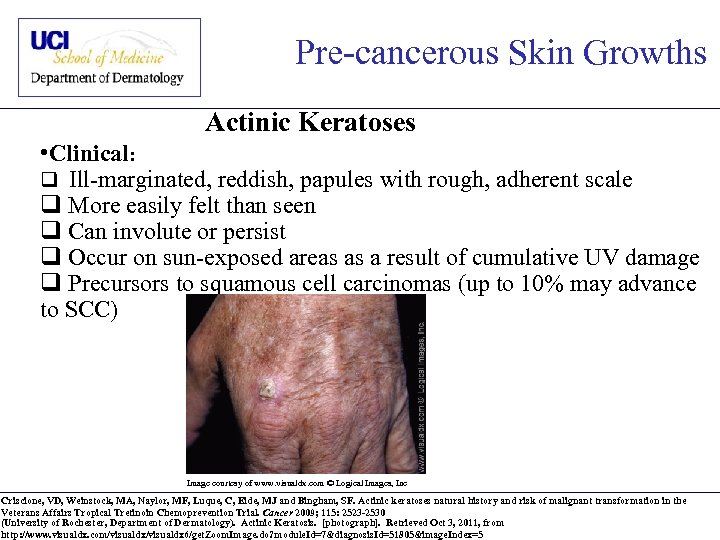 Pre-cancerous Skin Growths Actinic Keratoses • Clinical: q Ill-marginated, reddish, papules with rough, adherent