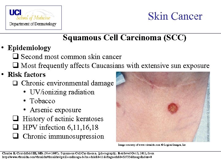 Skin Cancer Squamous Cell Carcinoma (SCC) • Epidemiology q Second most common skin cancer