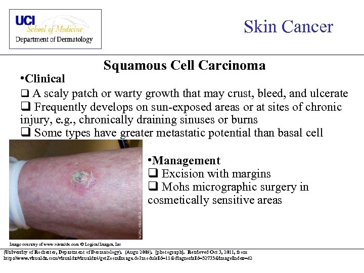 Skin Cancer Squamous Cell Carcinoma • Clinical q A scaly patch or warty growth