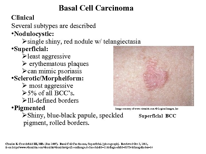 Basal Cell Carcinoma Clinical Several subtypes are described • Nodulocystic: Øsingle shiny, red nodule