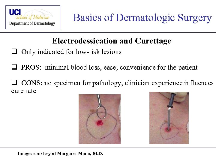 Basics of Dermatologic Surgery Electrodessication and Curettage q Only indicated for low-risk lesions q