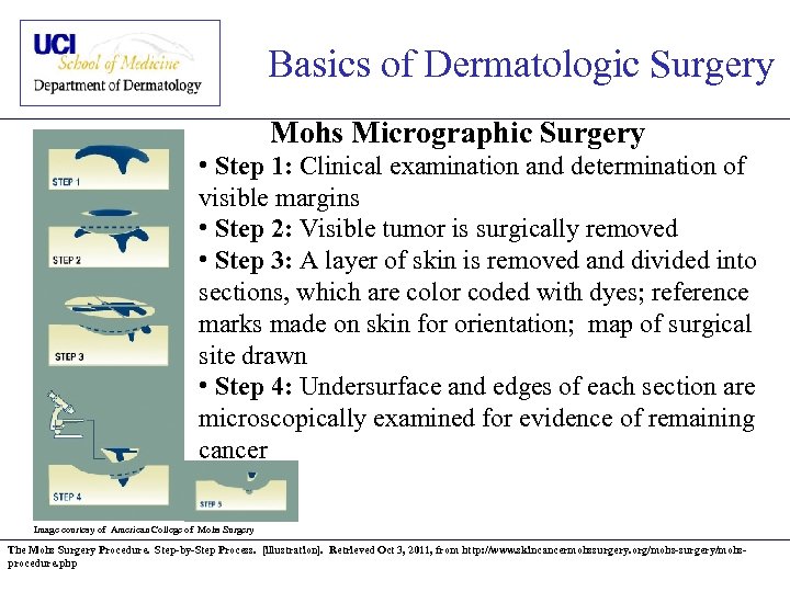 Basics of Dermatologic Surgery Mohs Micrographic Surgery • Step 1: Clinical examination and determination