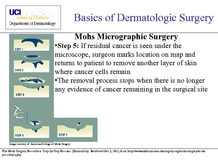 Basics of Dermatologic Surgery Mohs Micrographic Surgery • Step 5: If residual cancer is