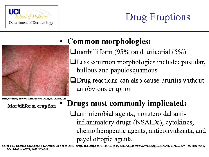 Drug Eruptions • Common morphologies: qmorbilliform (95%) and urticarial (5%) q. Less common morphologies