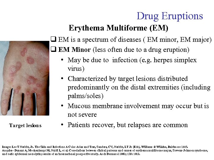 Drug Eruptions Erythema Multiforme (EM) Target lesions q EM is a spectrum of diseases