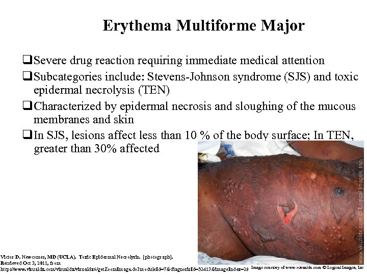 Erythema Multiforme Major q. Severe drug reaction requiring immediate medical attention q. Subcategories include: