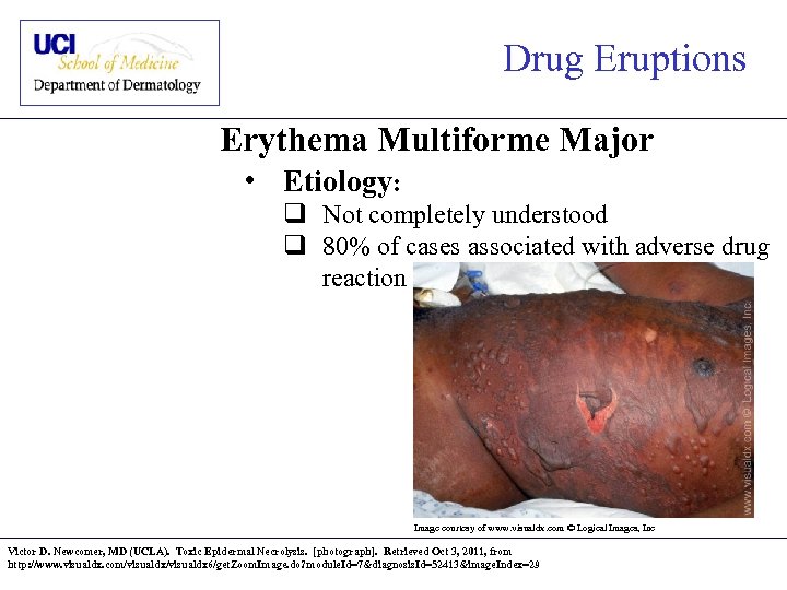 Drug Eruptions Erythema Multiforme Major • Etiology: q Not completely understood q 80% of