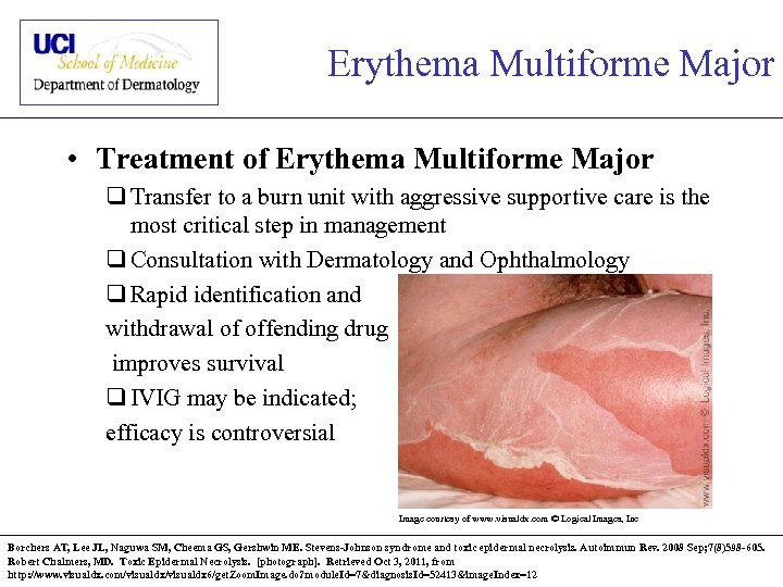 Erythema Multiforme Major • Treatment of Erythema Multiforme Major q Transfer to a burn