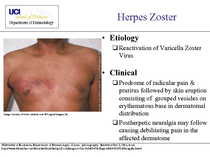 Herpes Zoster • Etiology q Reactivation of Varicella Zoster Virus • Clinical Image courtesy