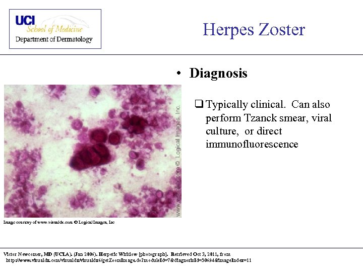 Herpes Zoster • Diagnosis q Typically clinical. Can also perform Tzanck smear, viral culture,