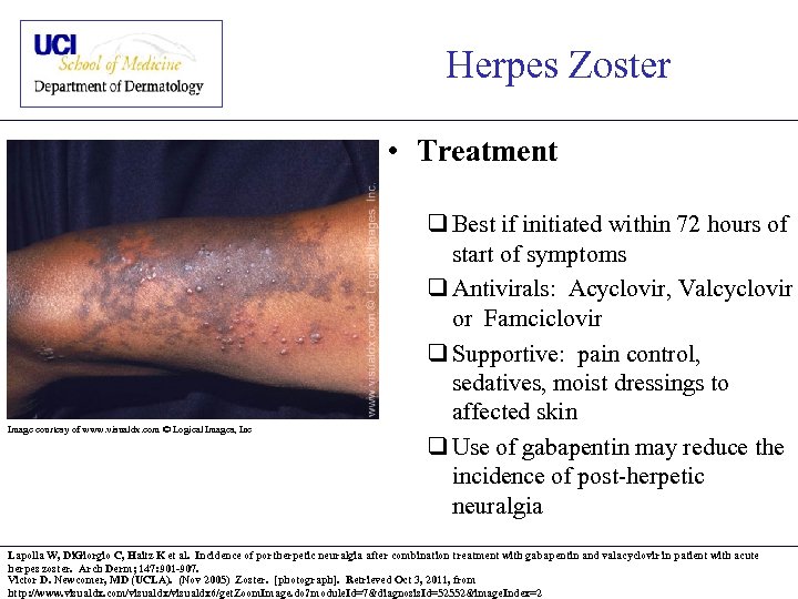 Herpes Zoster • Treatment Image courtesy of www. visualdx. com © Logical Images, Inc