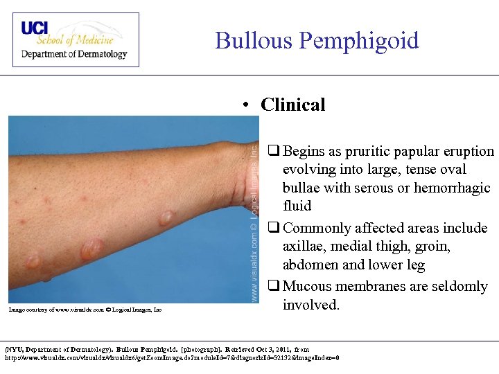 Bullous Pemphigoid • Clinical Image courtesy of www. visualdx. com © Logical Images, Inc