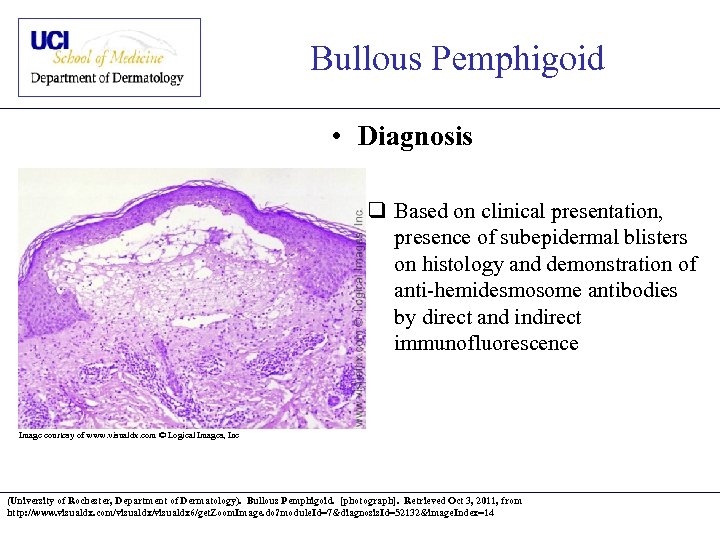 Bullous Pemphigoid • Diagnosis q Based on clinical presentation, presence of subepidermal blisters on