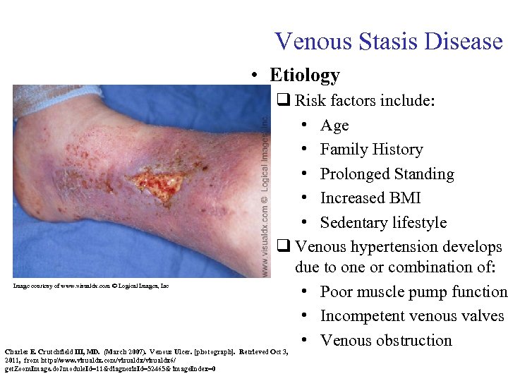 Venous Stasis Disease • Etiology q Risk factors include: • Age • Family History